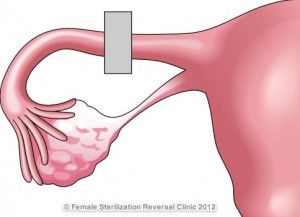 Sterilization 1
