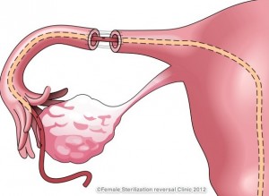 Sterilization 3
