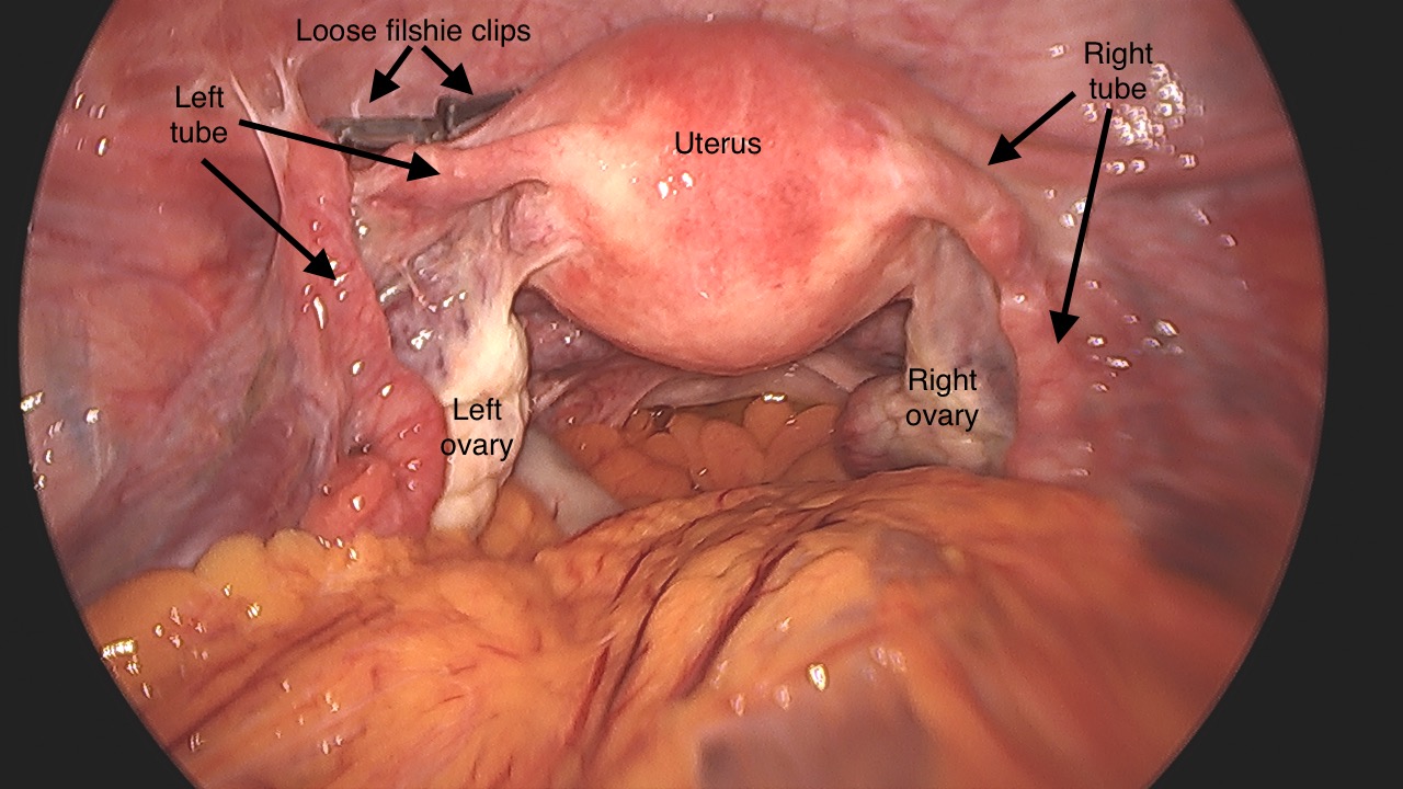 keyhole female sterilisation reversal