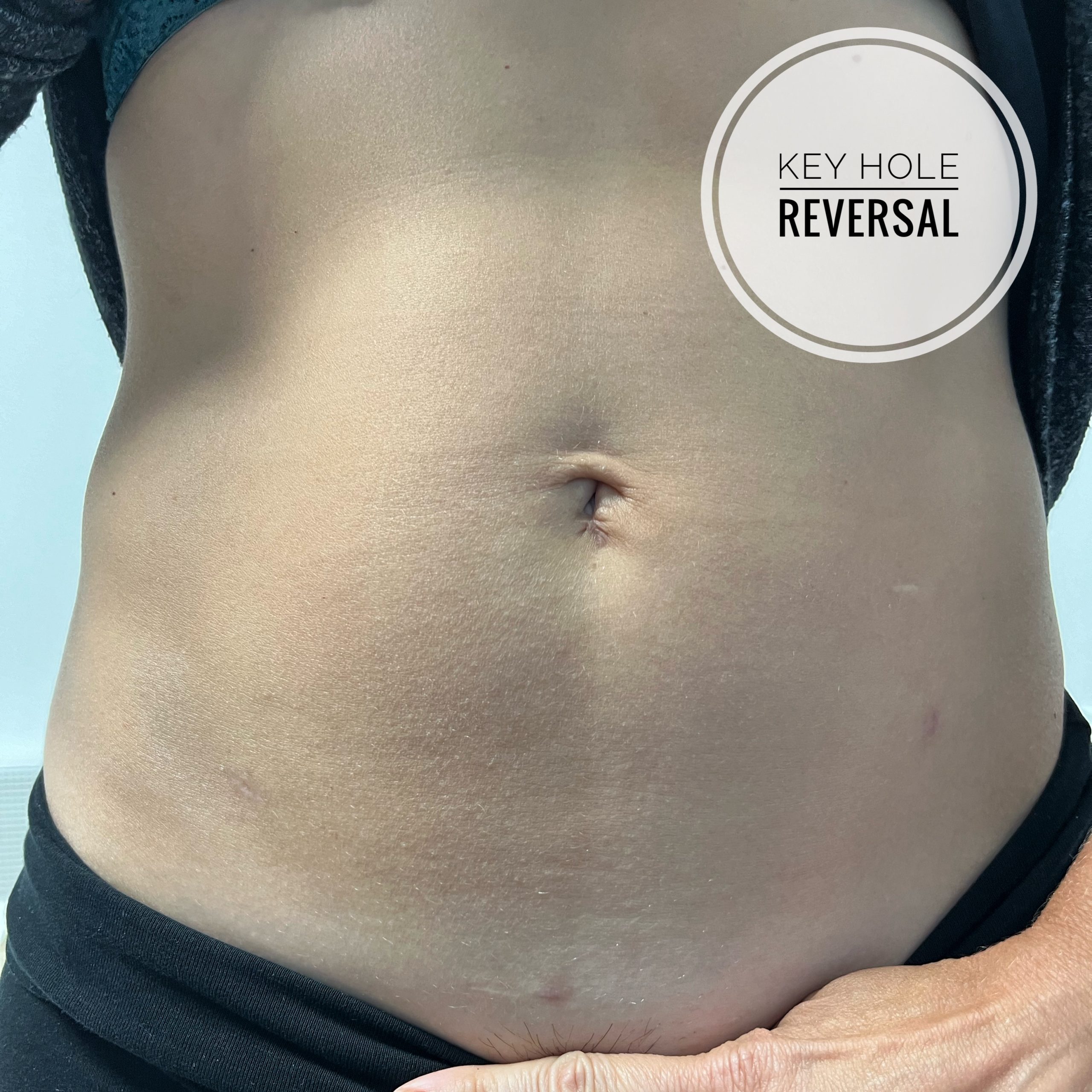 Laparoscopic reversal