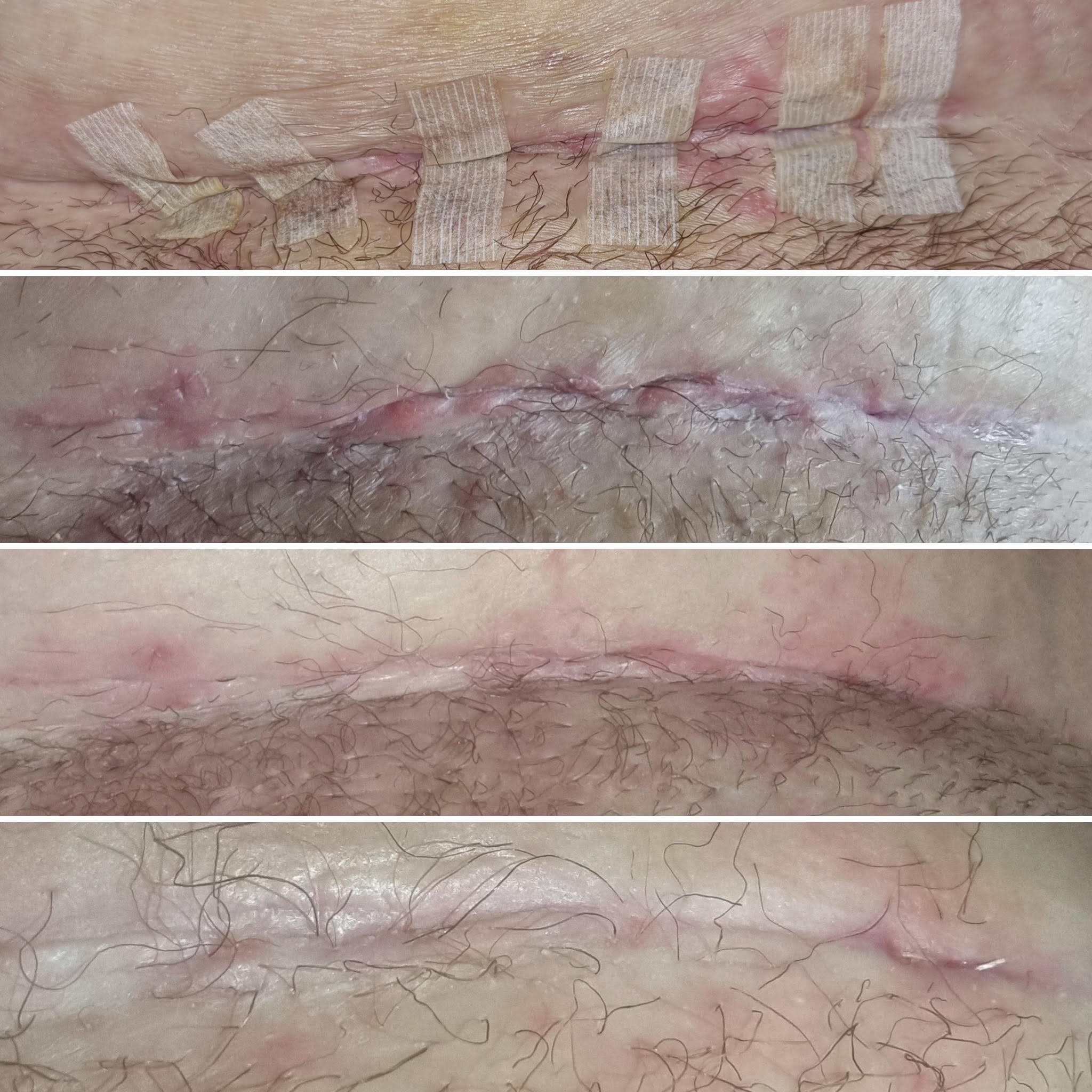 scarring after sterilisation reversal